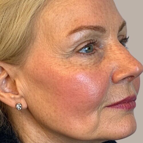Redness Not Settling Down?